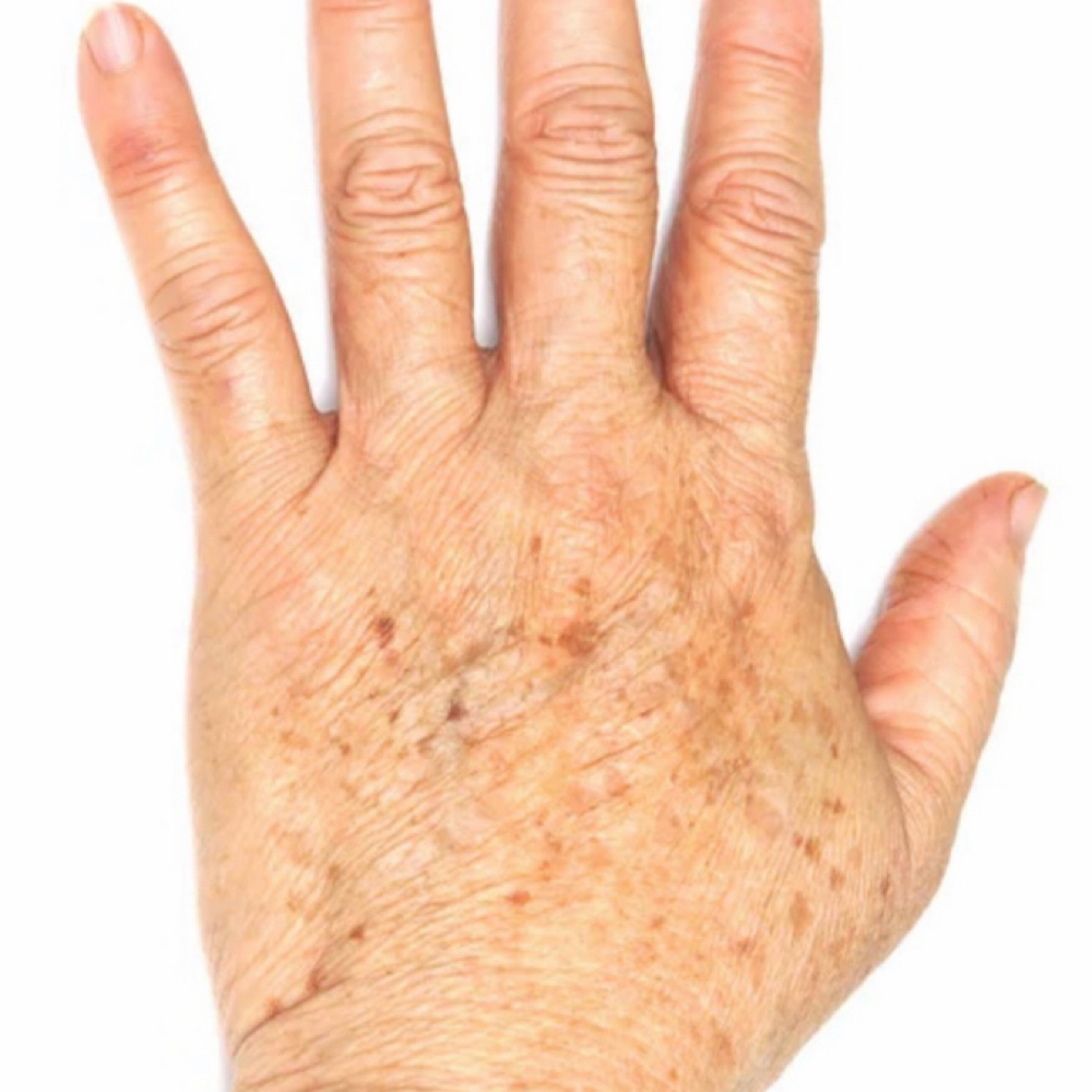 IPL Hand Rejuvination at Island Glow in Londonderry, NH