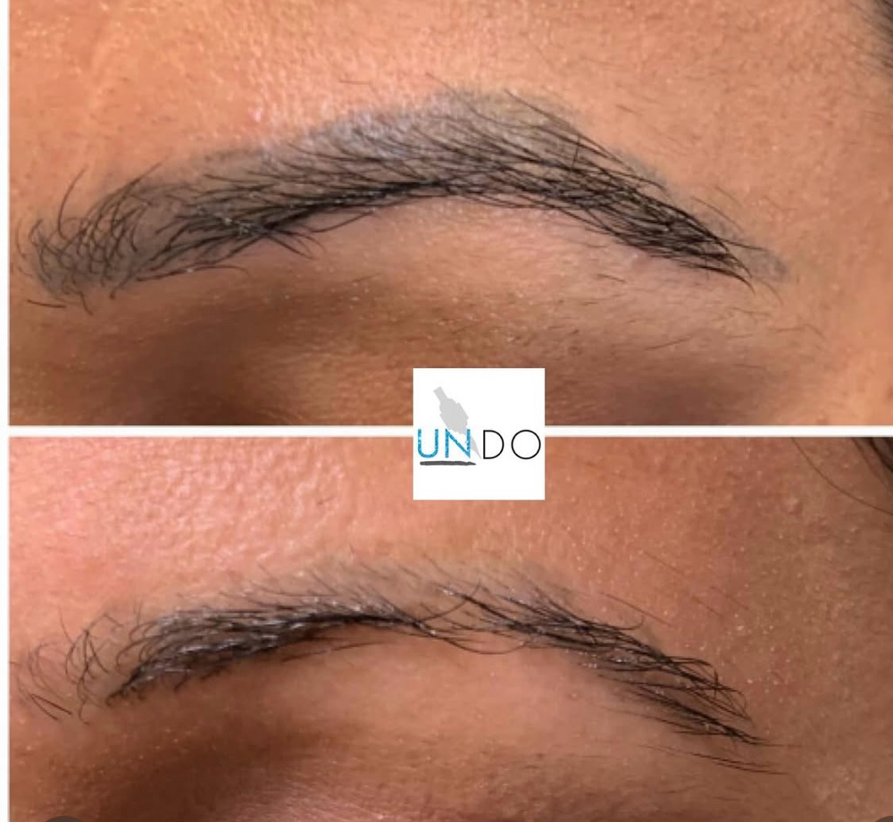 Undo Tattoo Removal at Ink Beauty Studio in McAllen, TX