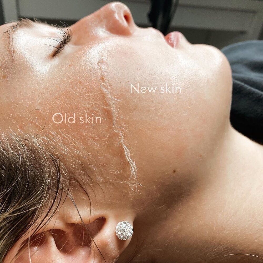 DERMAPLANING FACIAL