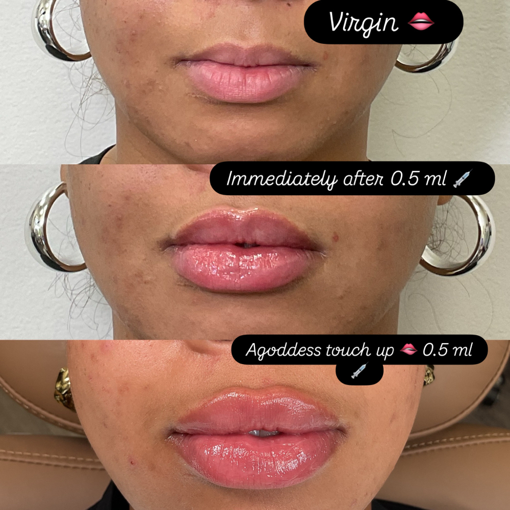 Lip Filler at Agoddess Spa & Wellness in DeSoto, TX