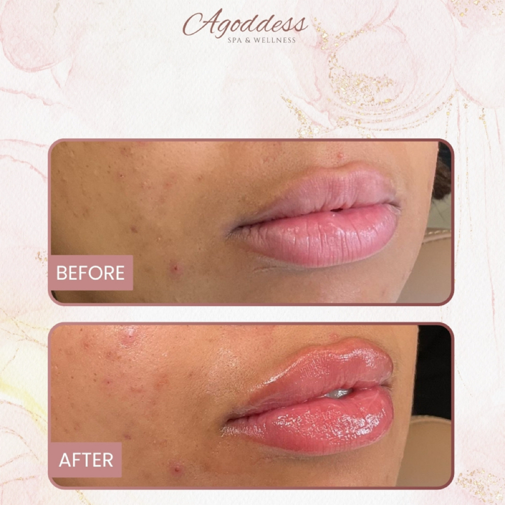 Lip Filler at Agoddess Spa & Wellness in DeSoto, TX