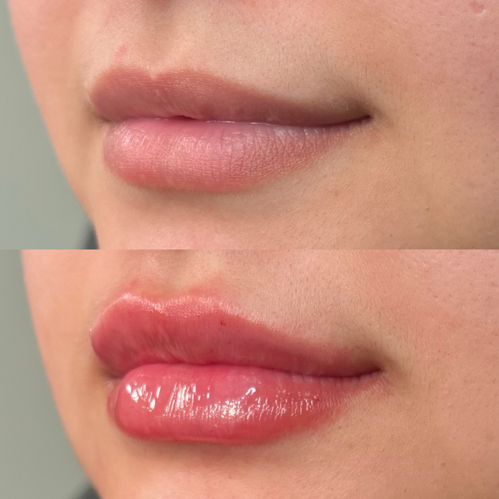 Lip Filler