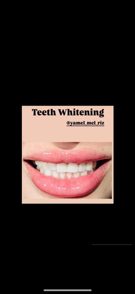 Teeth Whitening Touch-up Session