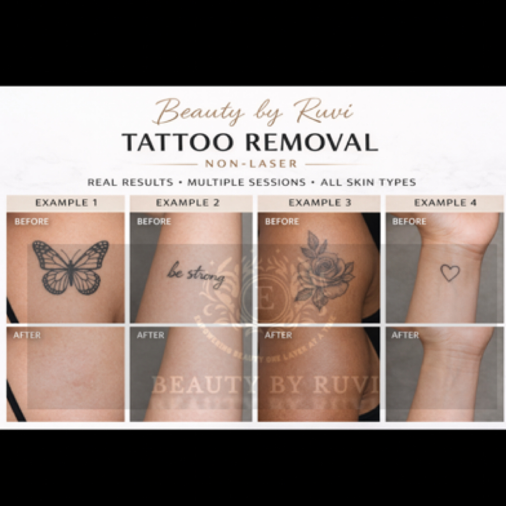 Non Laser Tattoo Removal at Beauty By Ruvi in Miami Gardens, FL