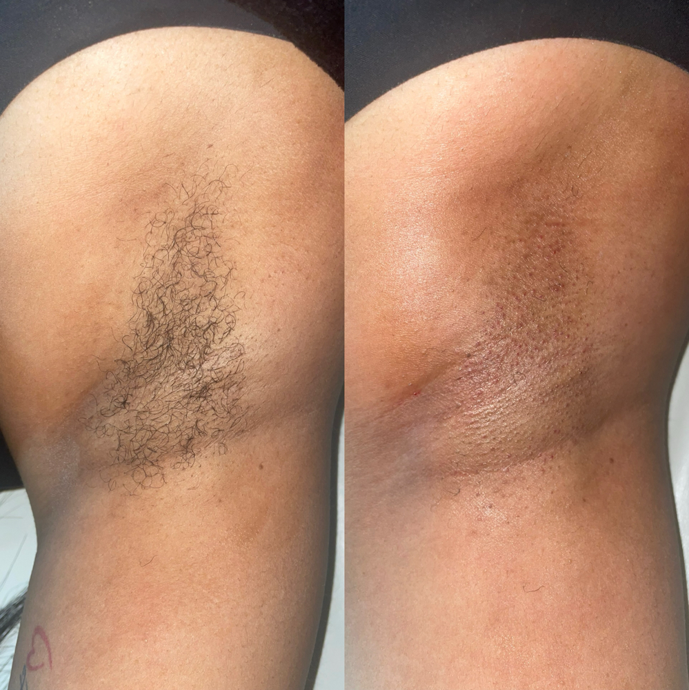 Arm Pits at Elegant Beautie in Birmingham, AL