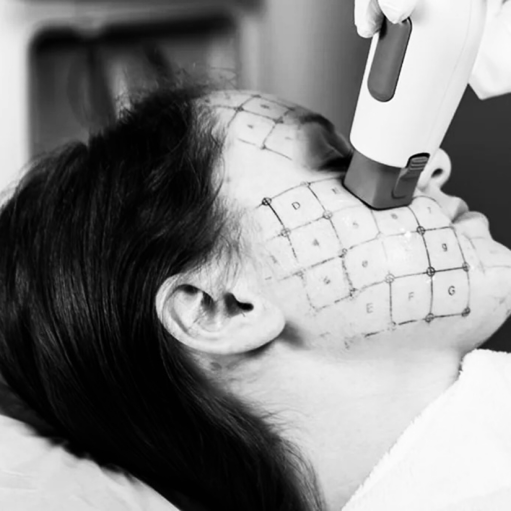 5th Gen ThermageFLX at Rose And Thorn Day Spa in Wheat Ridge, CO