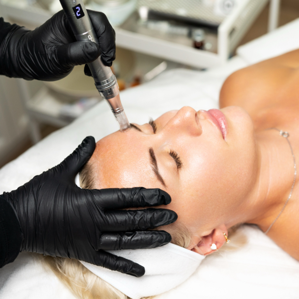Microneedle (bundle of 3) at Lunar Beauty Suites in Logan, UT