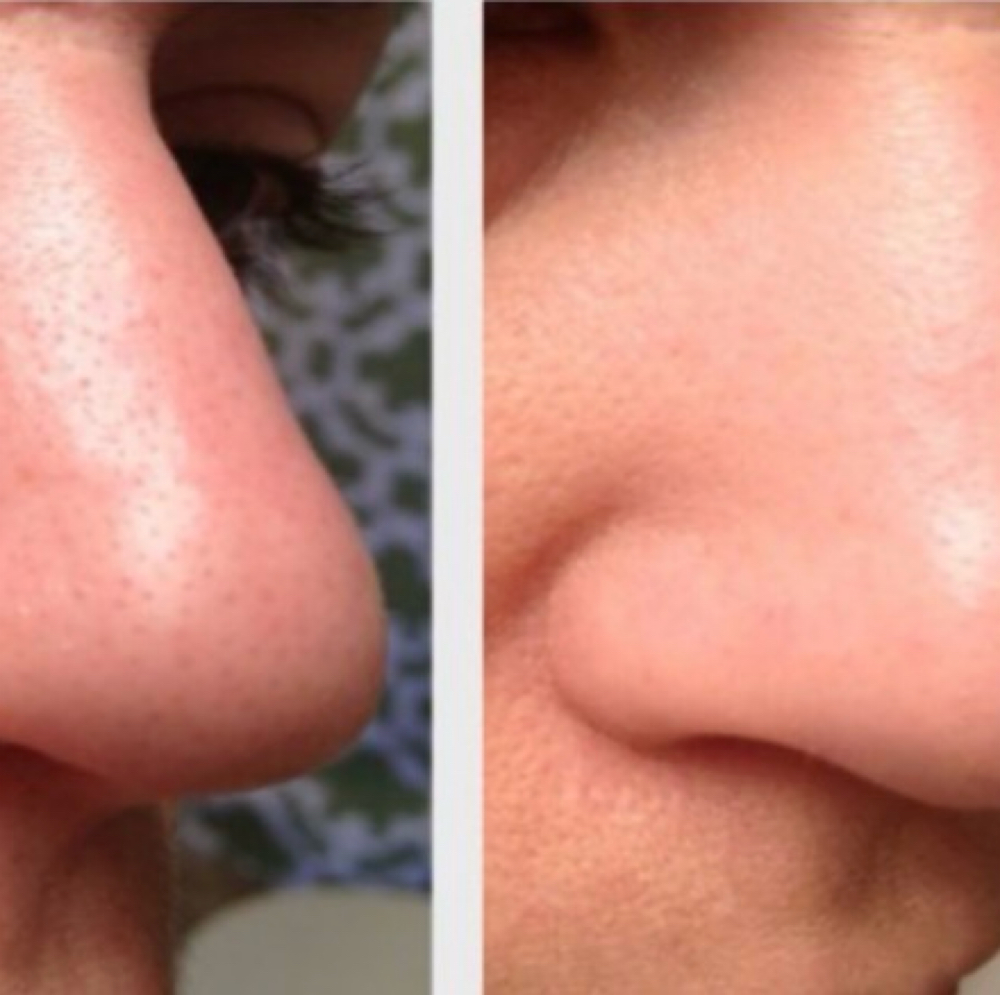 Blackhead Removal at Bliss Beauty Bar in Houston, TX