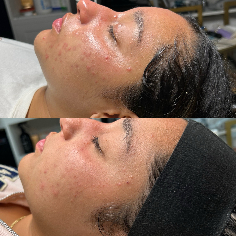 Clear Skin IV