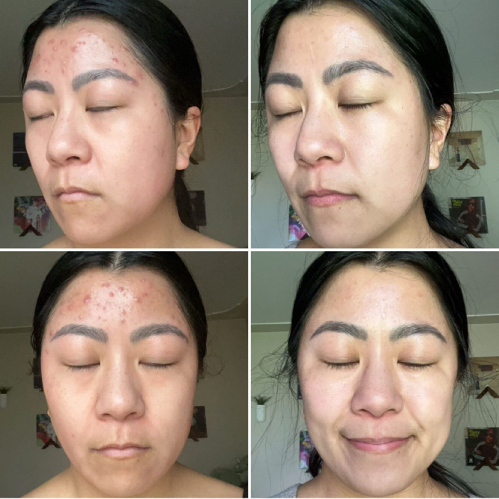 Spring Cleaning- 4 Advanced Peels at reBell Wellness in Grand rapids, MI