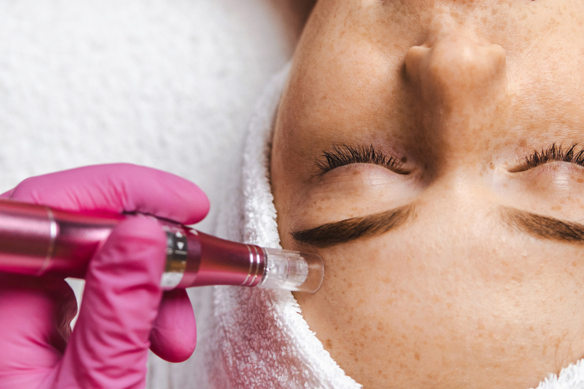 Microneedling