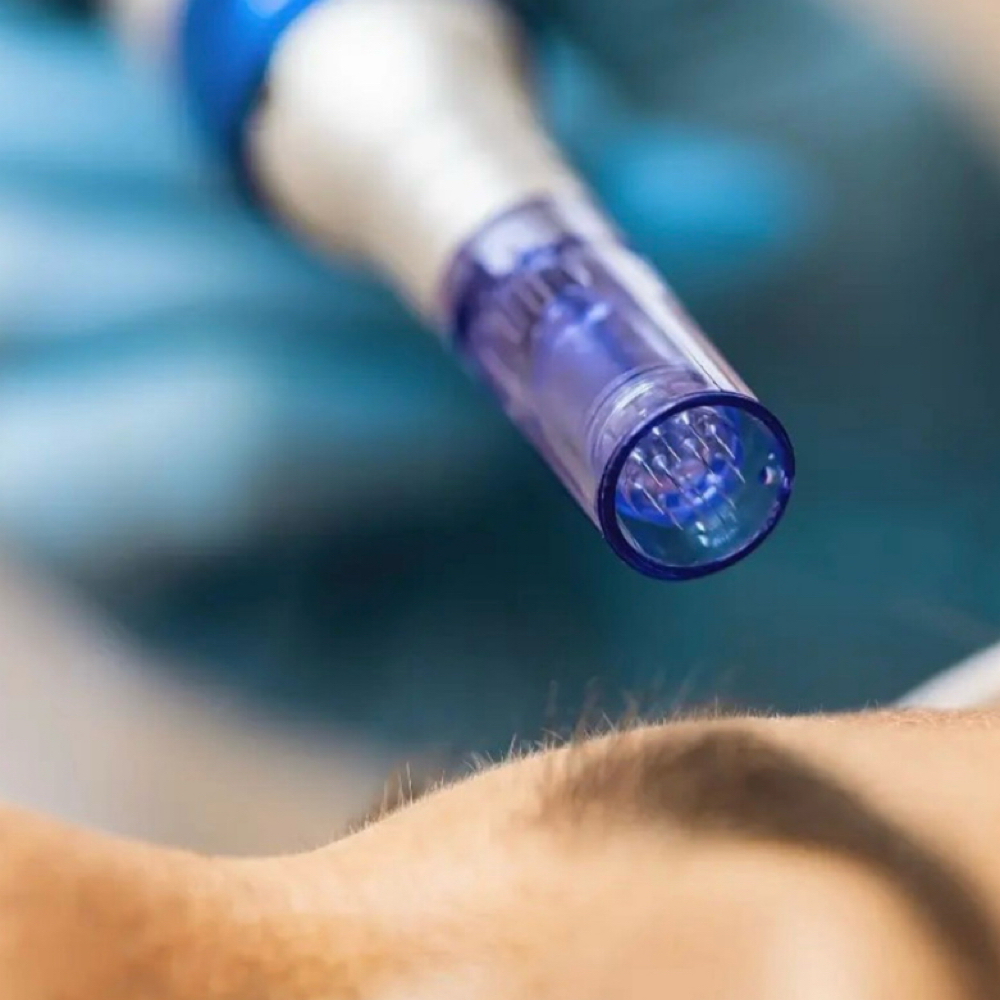 PRP & PDRN Treatment at Veras Aesthetics and Spa in Colorado Springs, CO