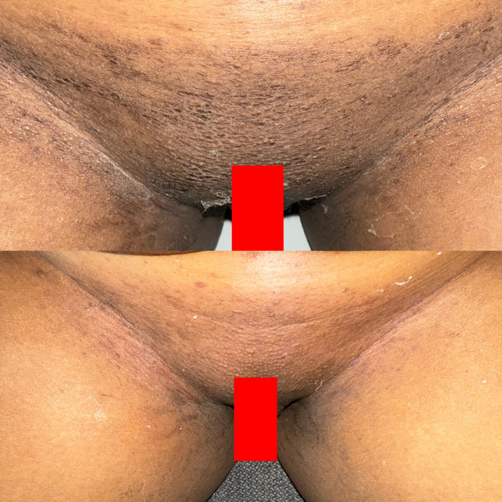 Intimate Bleaching Consultation