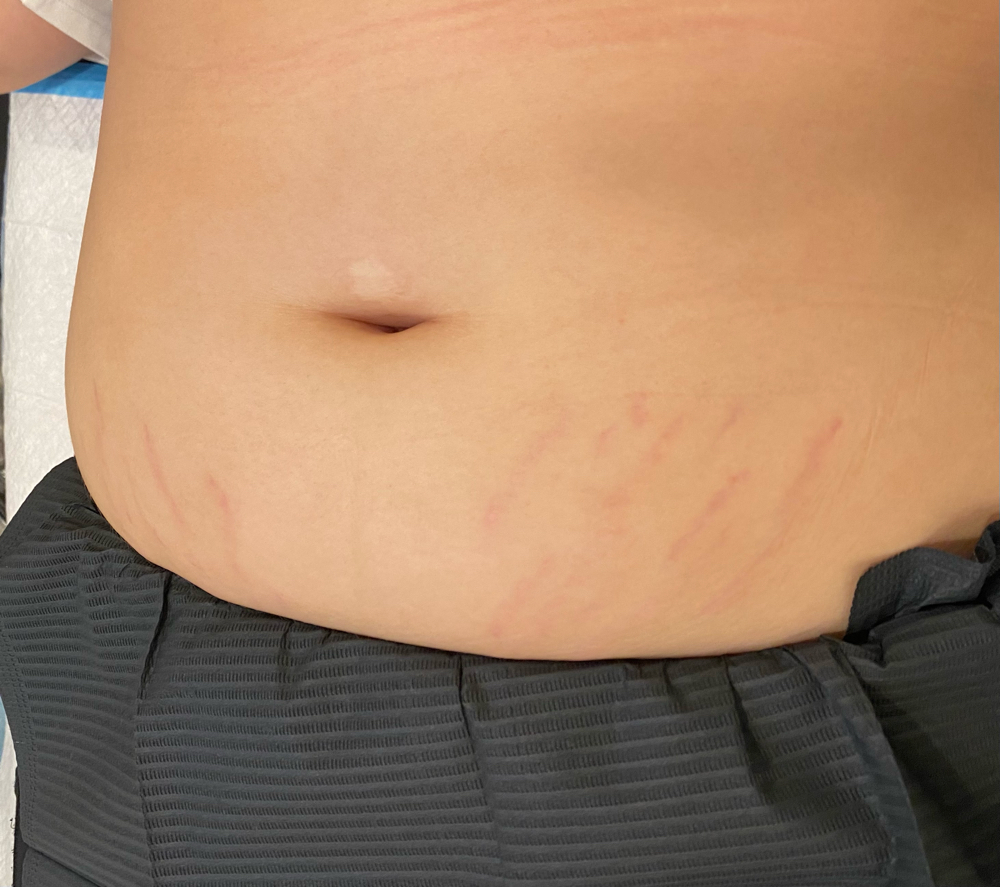 Inkless Strech Mark Revision