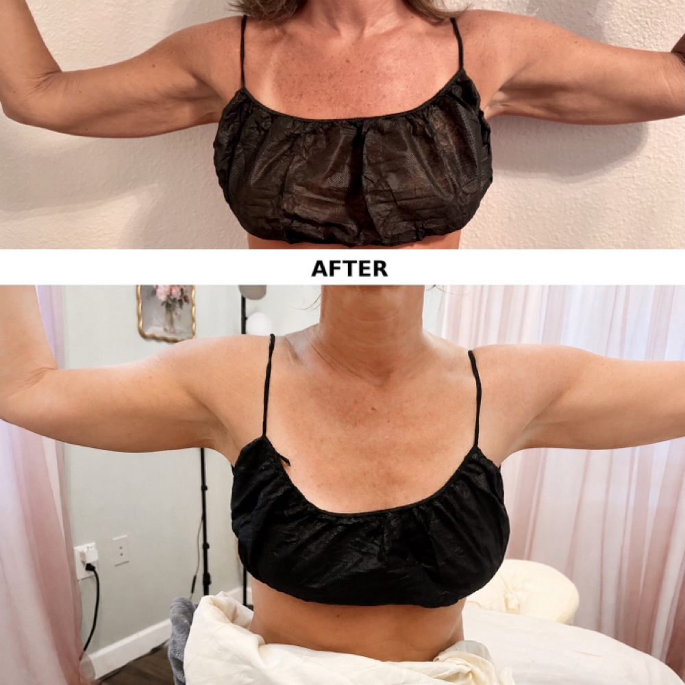 Fascia Fusion at GotSculptTampa in Tampa, FL