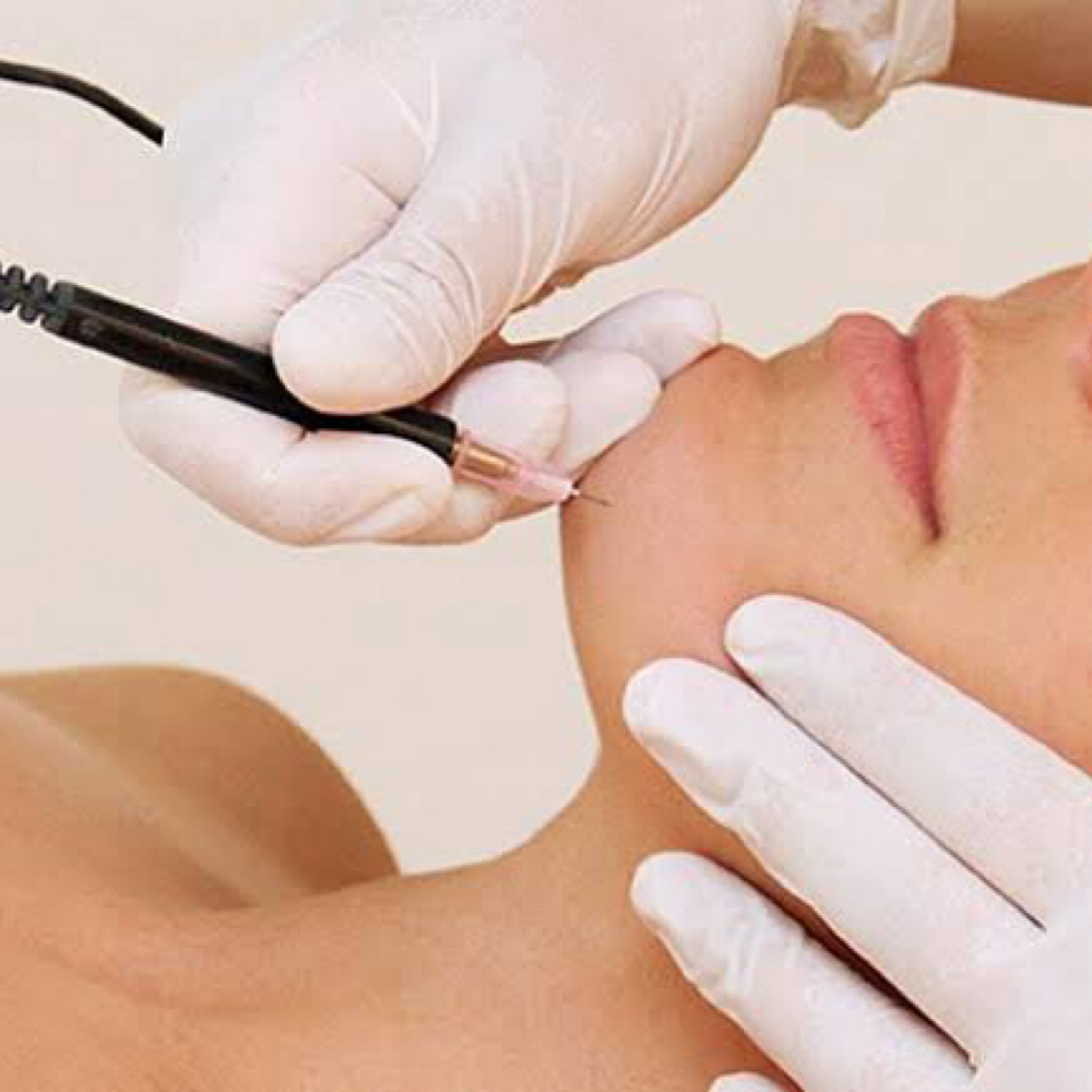 Electrolysis 15 Min Session at Eve Milan New York in White Plains, NY