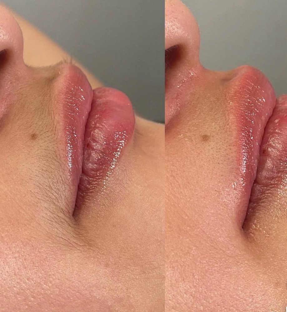 Upper Lip Wax at Chosen Esthetics in Pasadena, TX