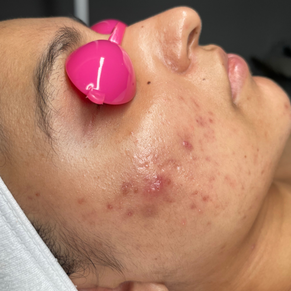 Acne Facial at Mimi Beauty Spa in Dallas, TX