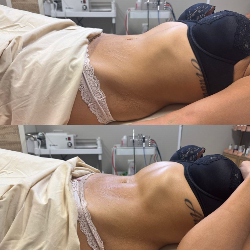 Lymphatic Sculpting at Project360 Aesthetics in Pearland, TX