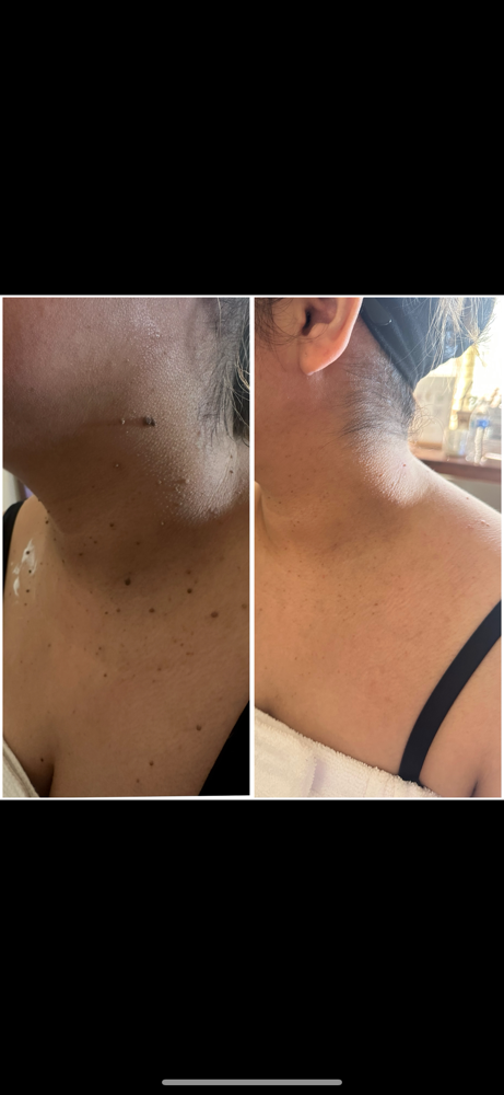 Skin Tags