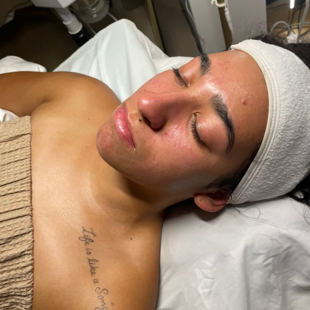 Acne Clearing Facial at Empire Beauty Bar in Wappingers Falls, NY