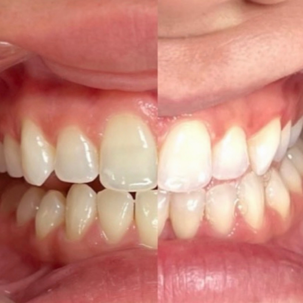 Teeth Whitening at Marie’s Brows And Lashes in Tyler, TX