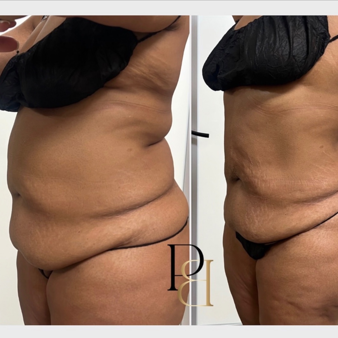1-Area Fat Dissolving Injections at Pleasures of Beautee in Atlanta, GA