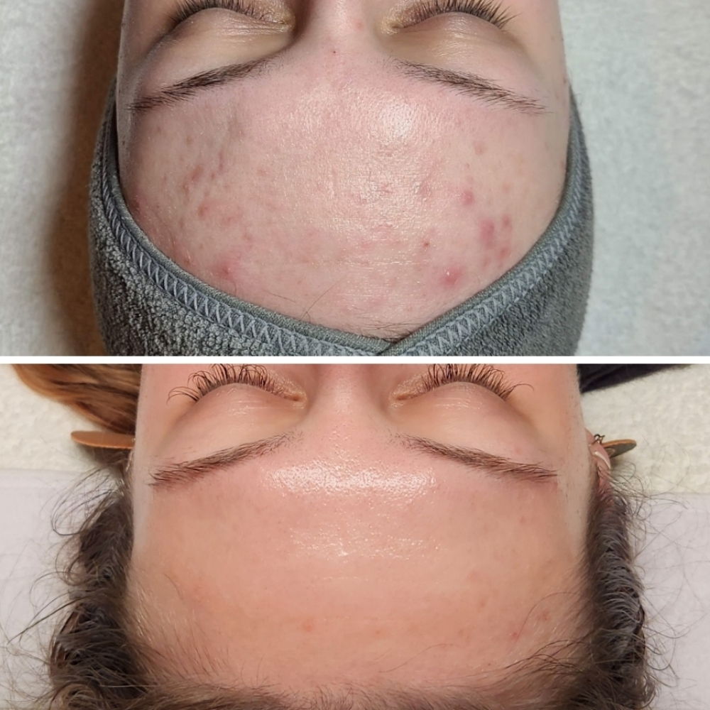 Acne Clearing Blue Light Therapy