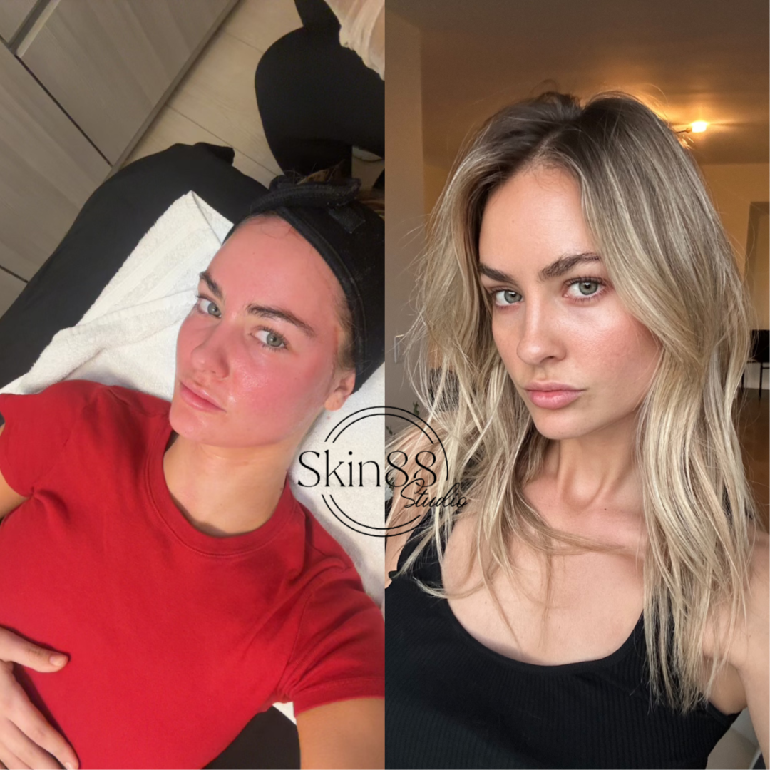 Microneedling In-Home Treatment at Skin88 Studio in Beverly Hills, CA