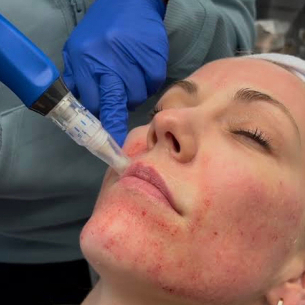 Microneedling In-Home Treatment at Skin88 Studio in Beverly Hills, CA
