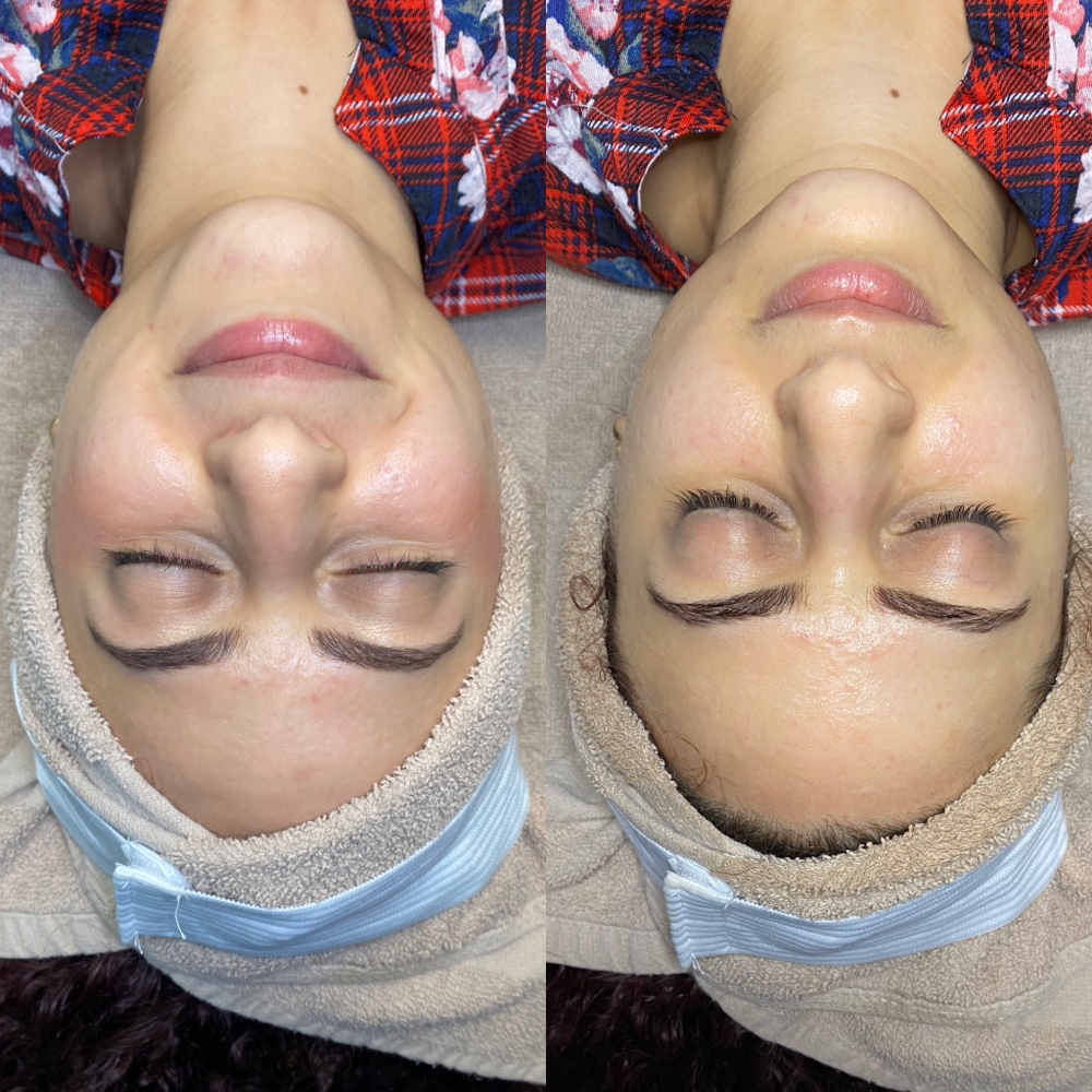 Customized Facial