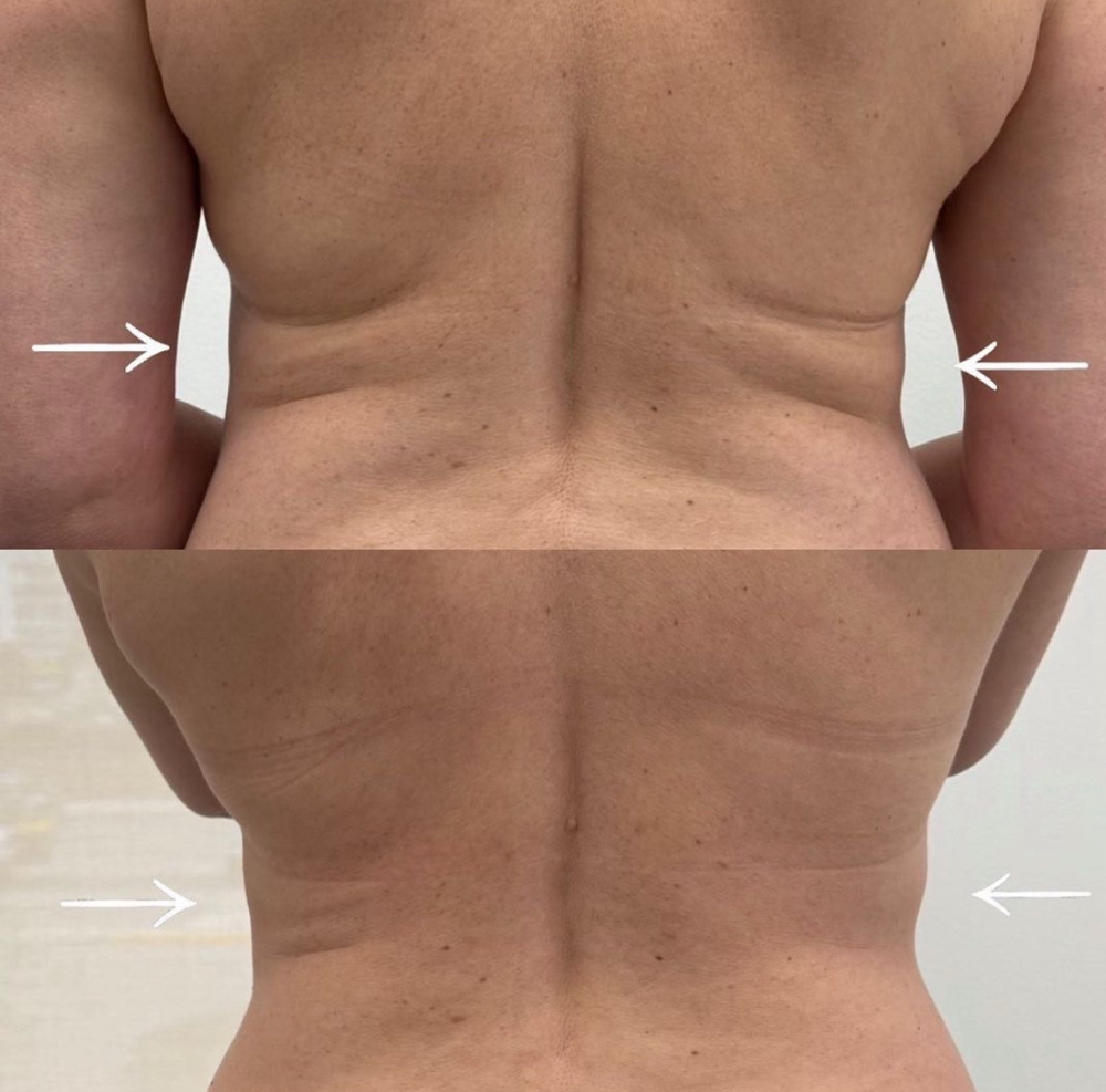 Waist Sculpt at Blossom Vanity Spa in Missouri City, TX