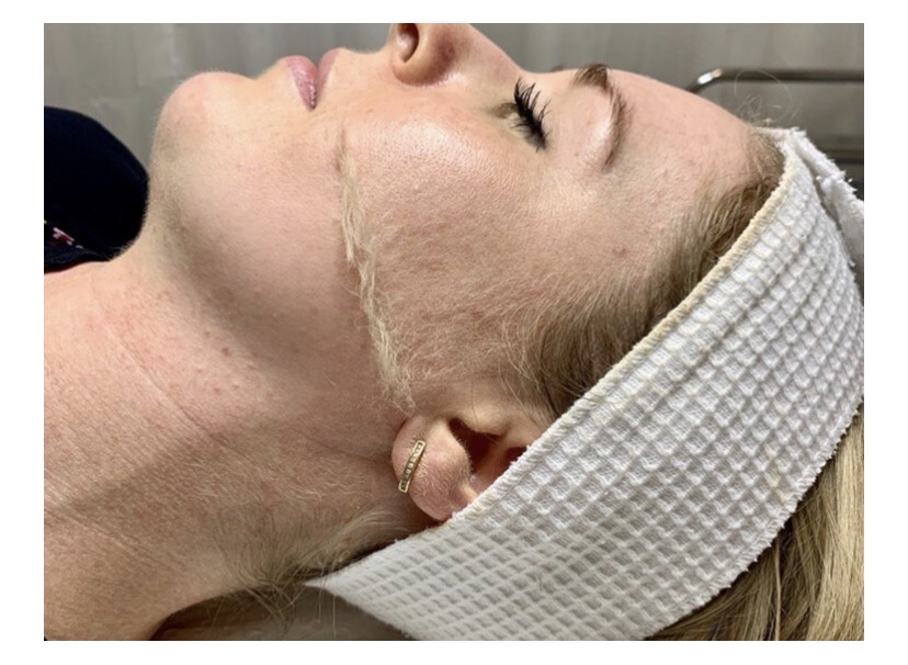 Dermaplane Add On