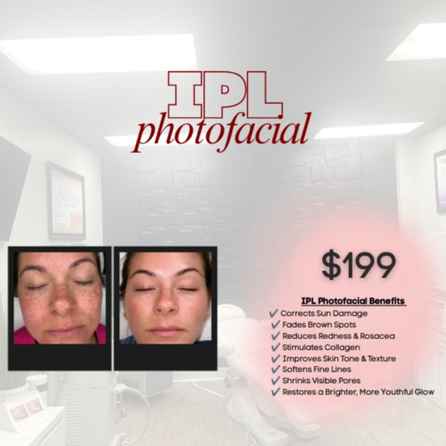 JUNE Dayz....IPL at The Skin Bar & Med Spa in Bryant, AR