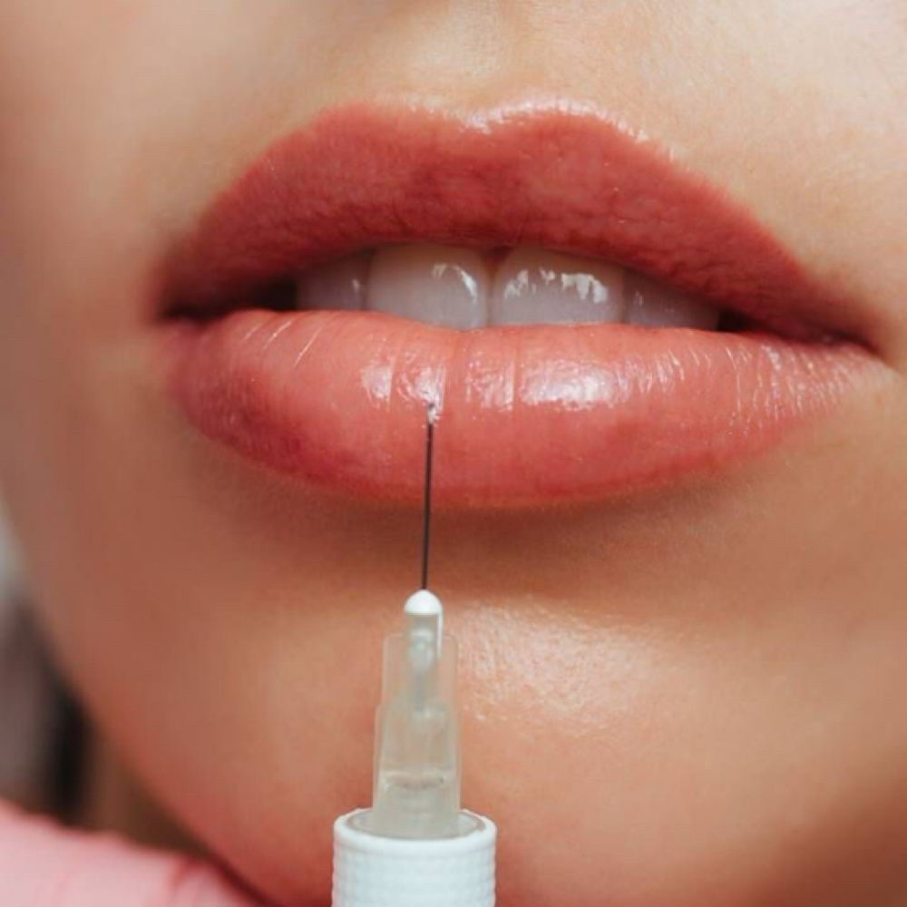 Lip Filler 1ml at Bare Aesthetics ATX in Austin, TX