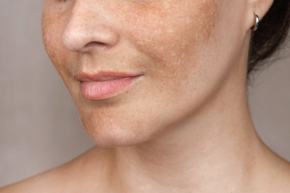 Melasma Laser Facial ( NO HEAT)