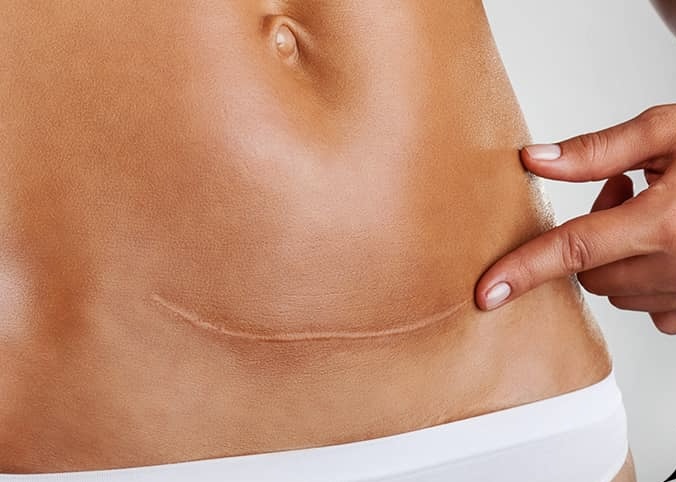 Micro-Needling Tummy Tuck