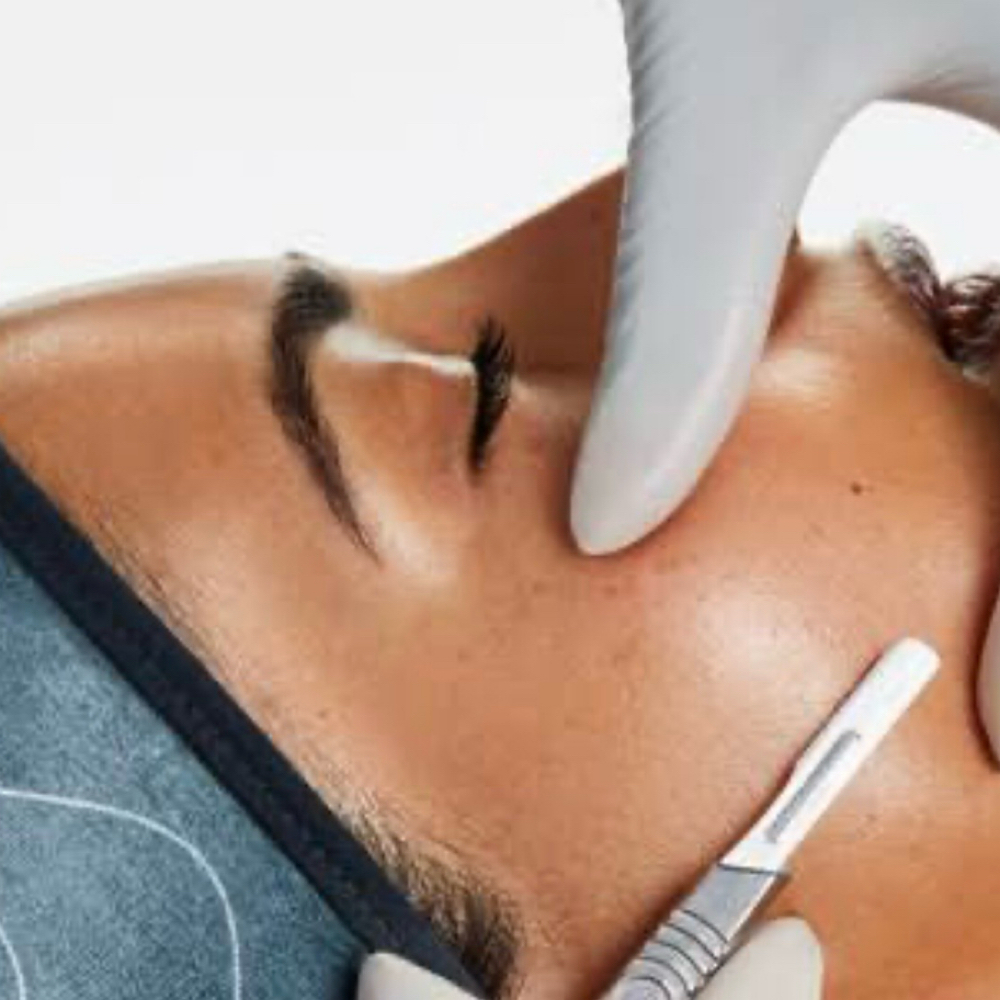 PRO Dermaplaning (NEW) at A&A POREFECTION in Amherst, NY