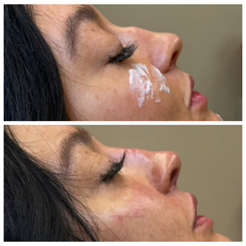 Nose Filler at Esteem Aesthetics, LLC in Charleston, WV