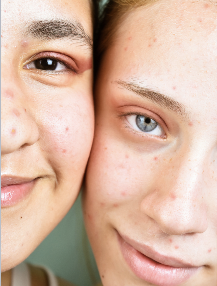 Acne Focused Facials