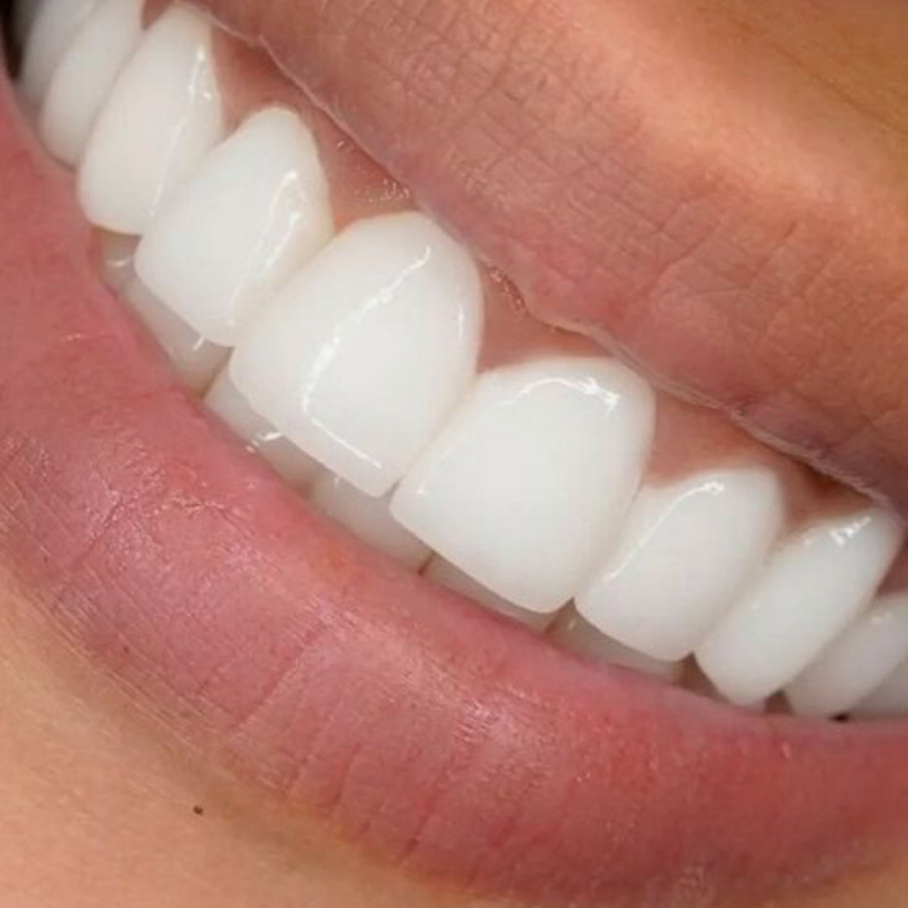 Teeth Whitening 30 MIN at Sebby  Studio in Shorewood, IL