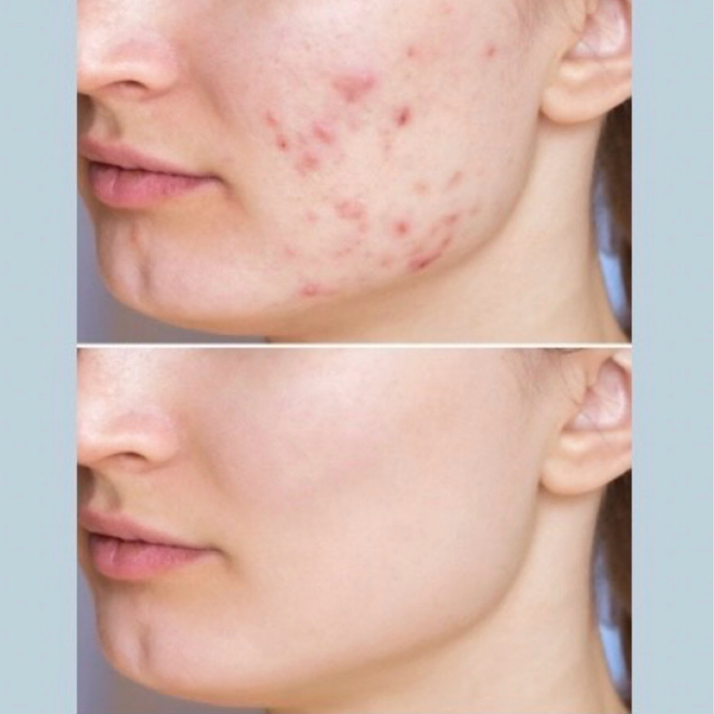 Acne Consultation + Treatment at Skin by Cydni in Atlanta, GA