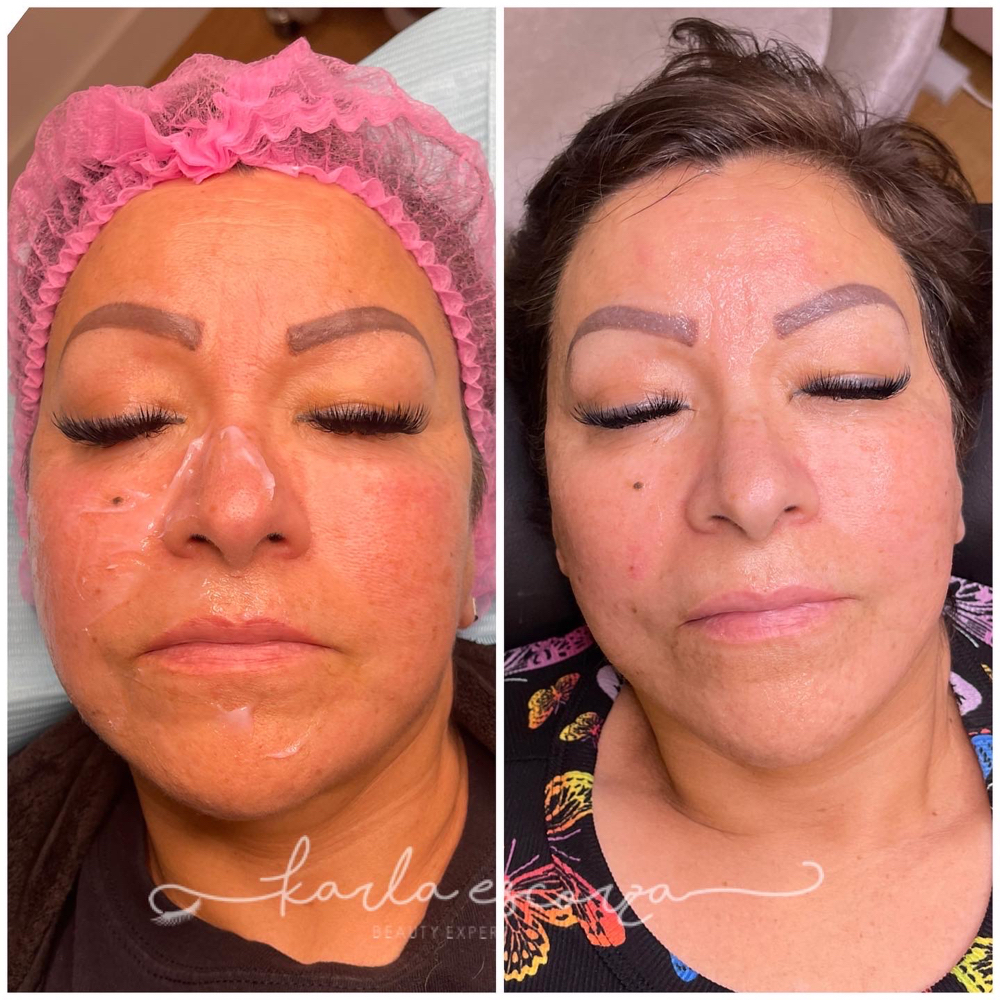 Full Face Fibroblast at LASHES AND BROWS By Karla Escorza in Northglenn, CO