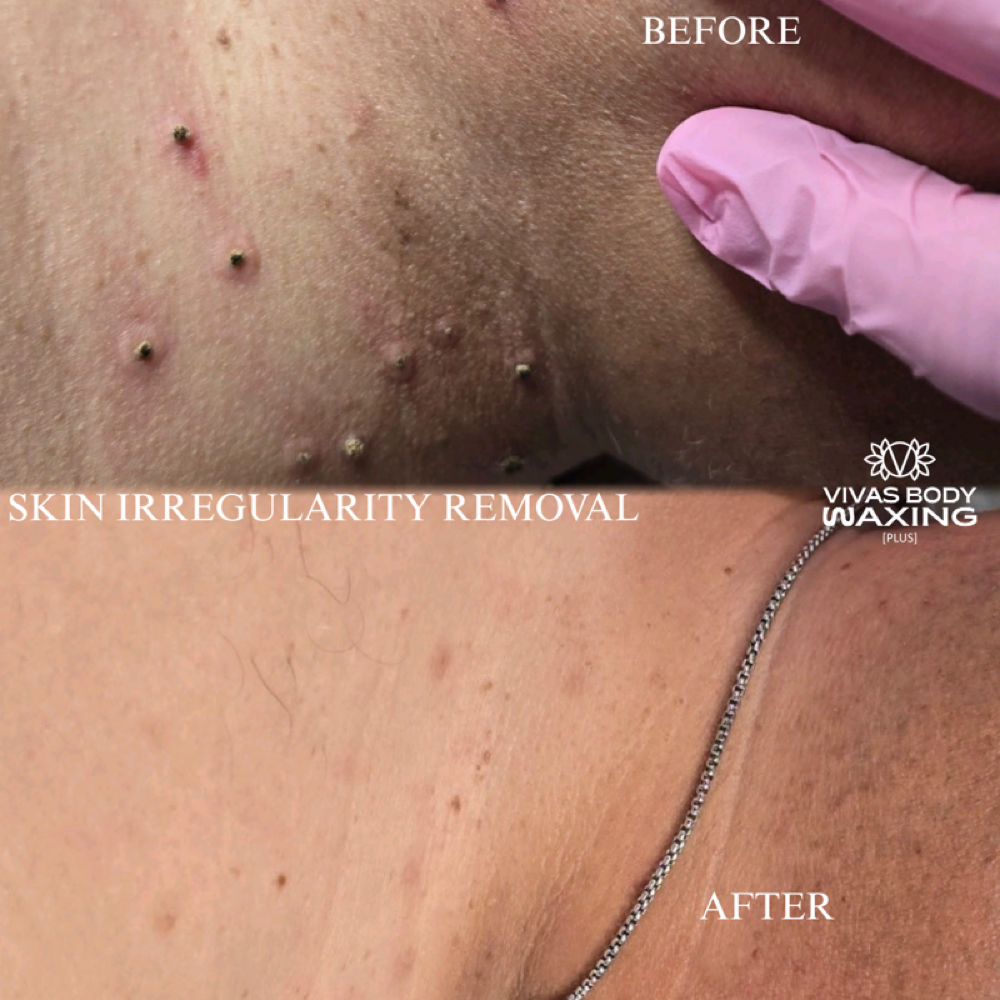 Skin irregularities at Vivas Body Waxing in Milwaukee, WI