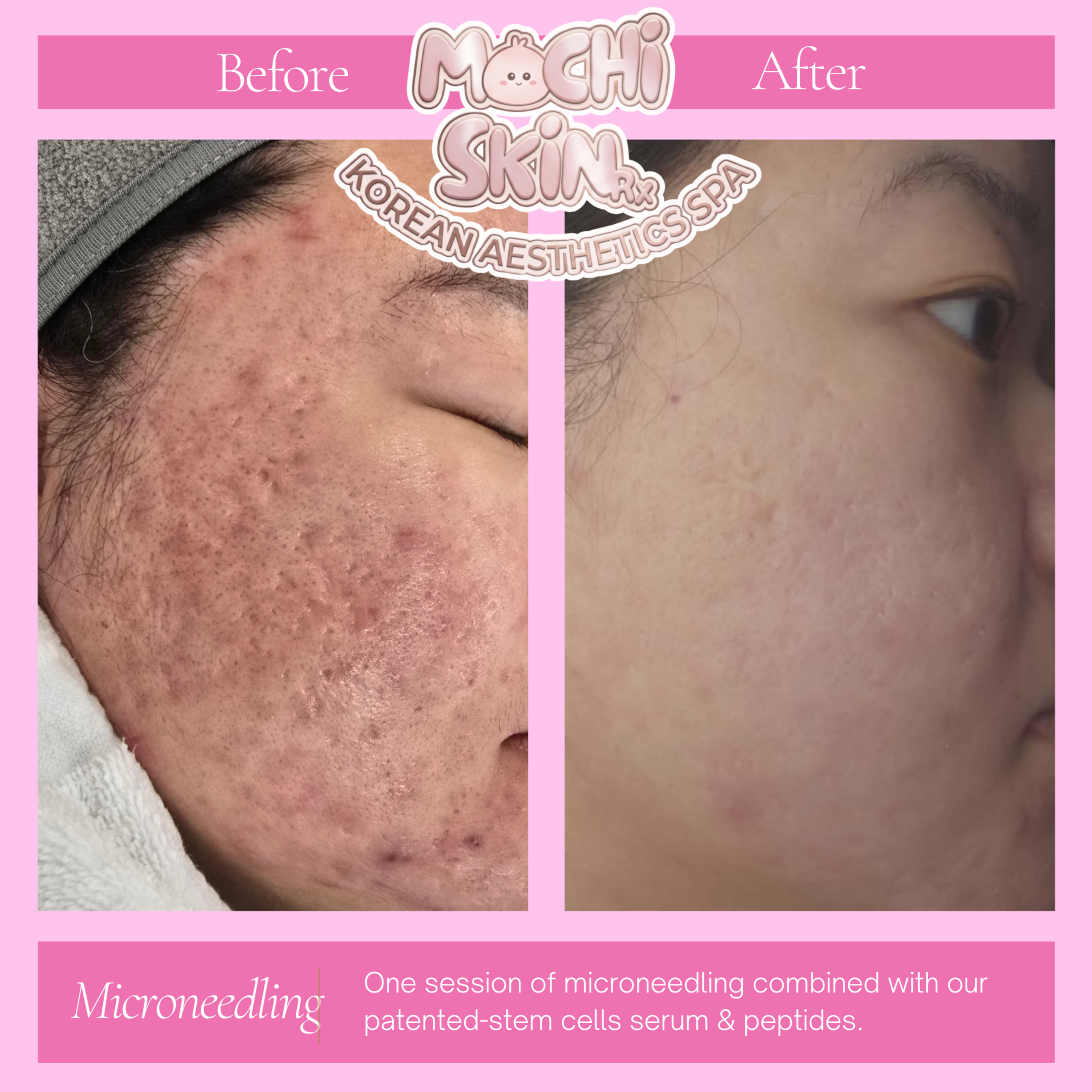 RF Microneedling at Mochi Skin Rx in Roseville, MN