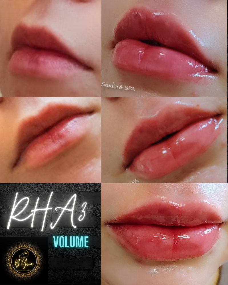 RHA 2/3