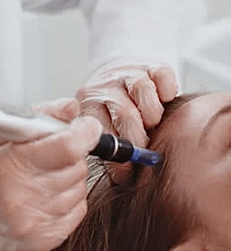 Exosome Microneedling Scalp
