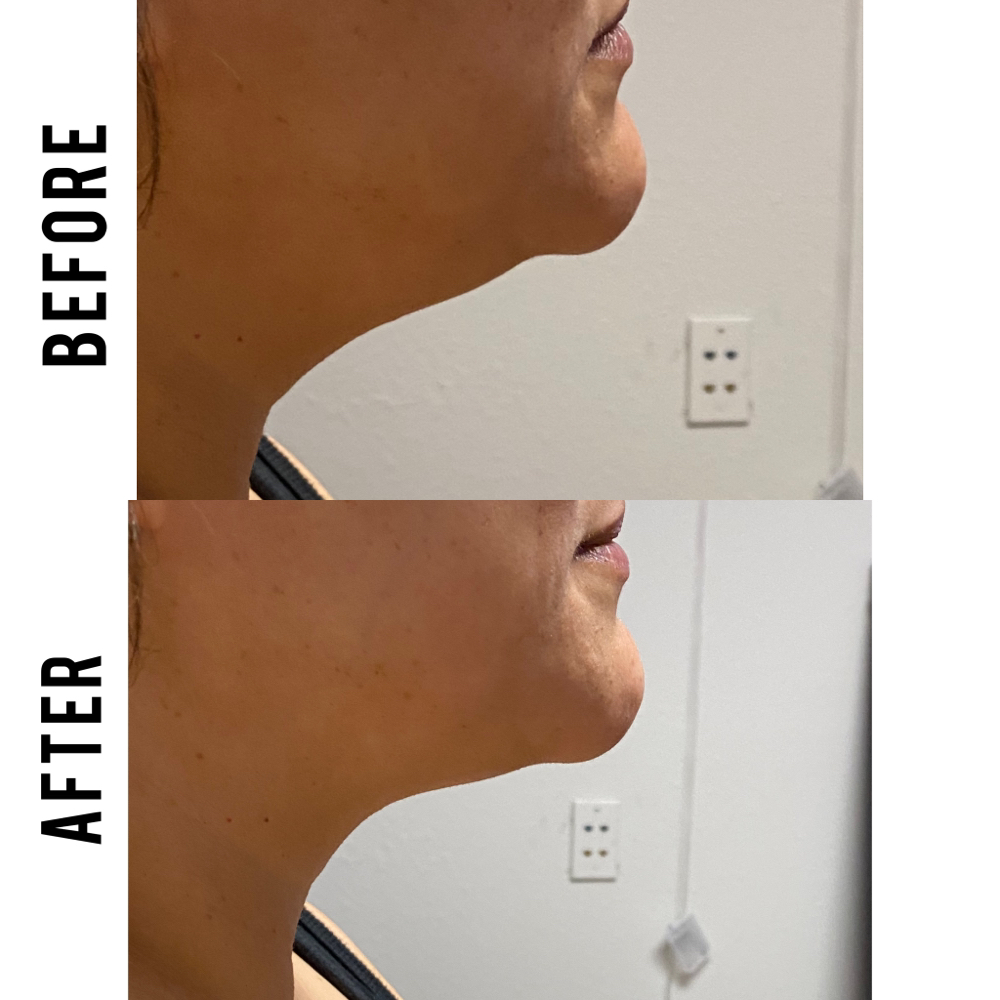 Double Chin Reduction