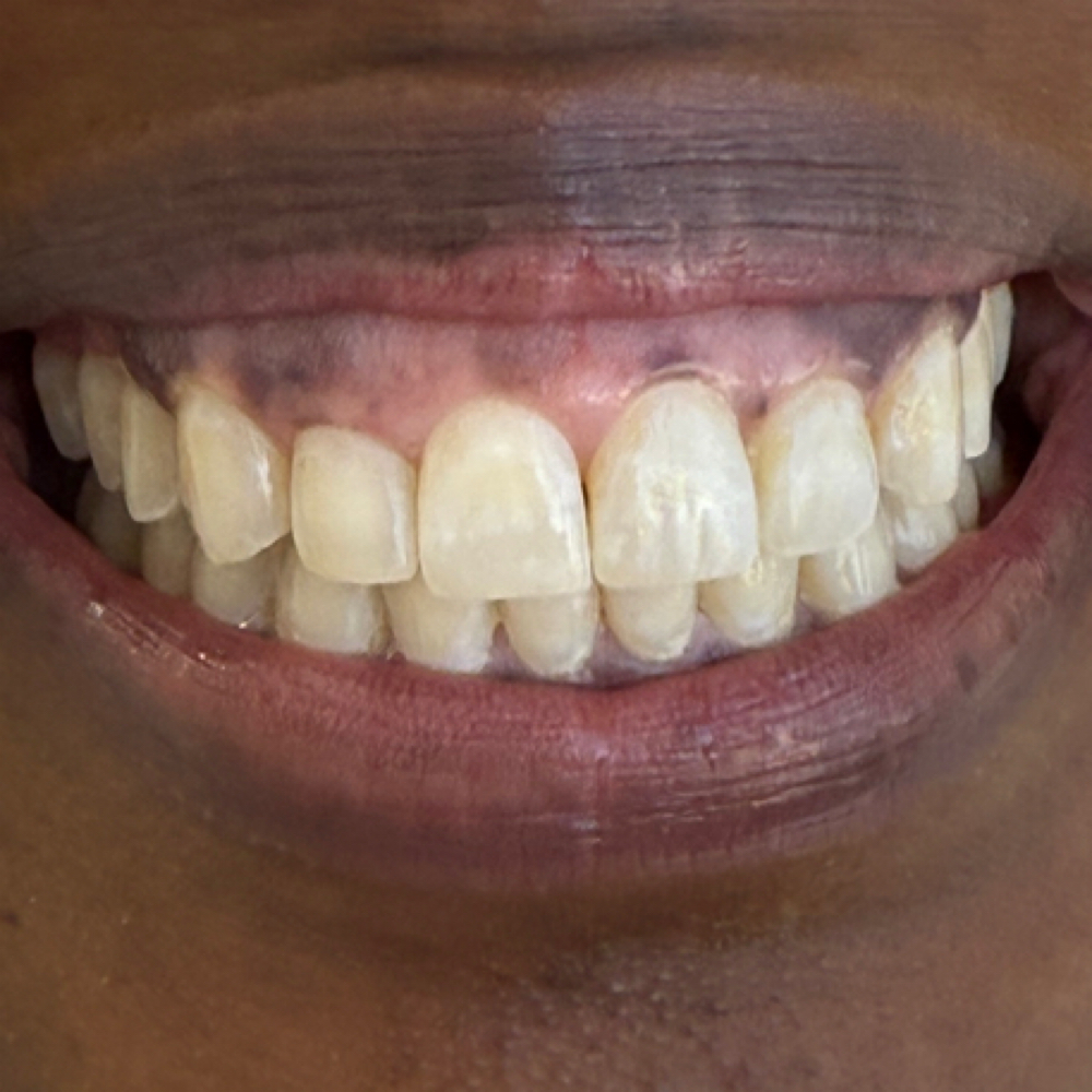 Teeth Whitening 20 Min at J Artistry in Sherman, TX