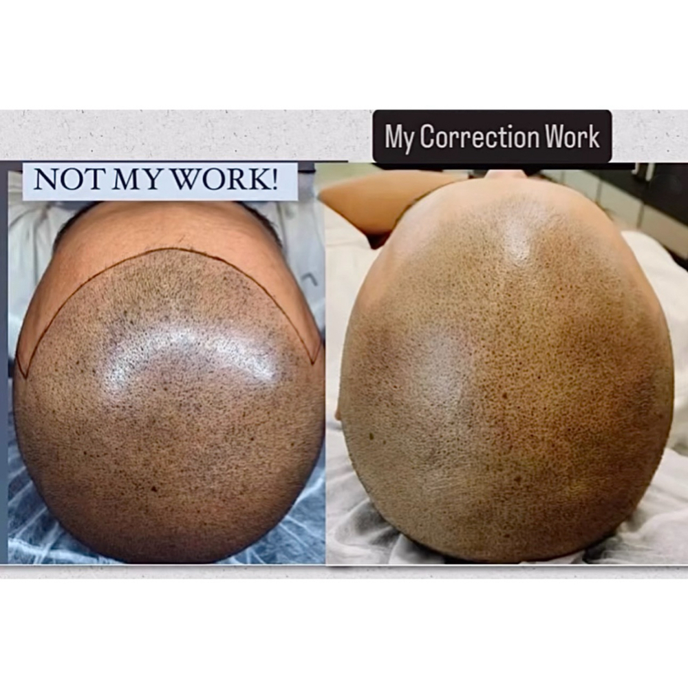 SMP Correction & Revision at Crown Aesthetx in Modesto, CA